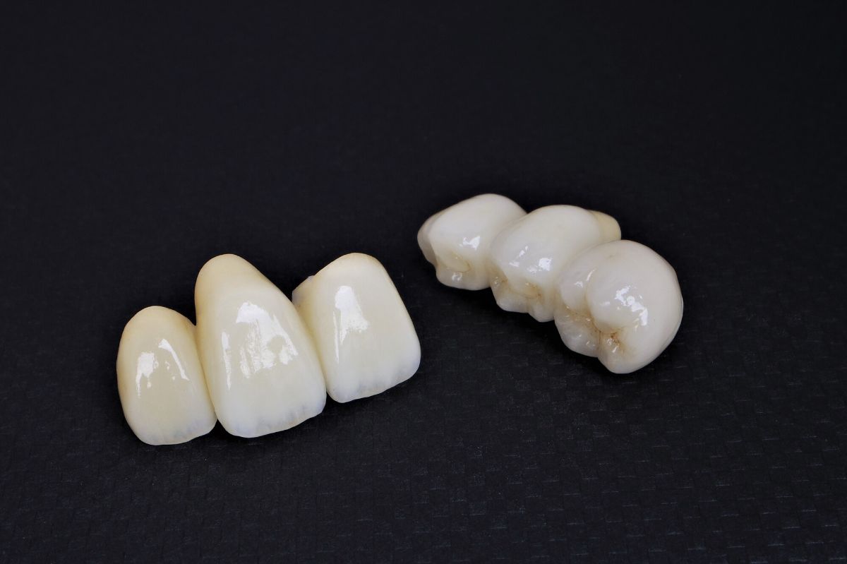 セラミックの被せ物